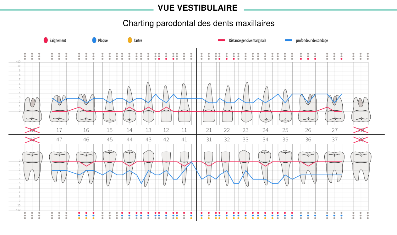 Exemple de périochart Parofirst : représentation des dents, mesures de sondage et repères de saignement, plaque et tartre